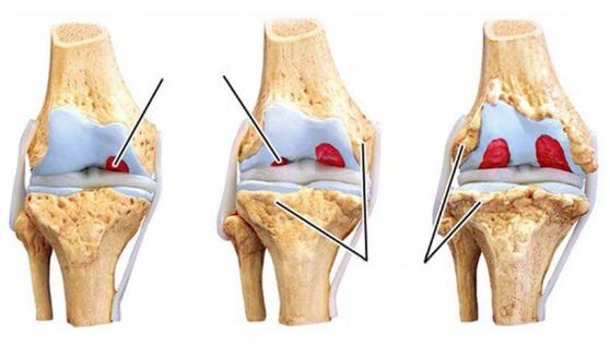 Grad-Arthrosis