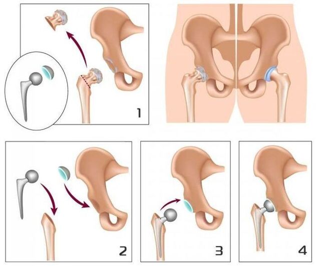 Ersatz e Halswéi mat enger Prothesis