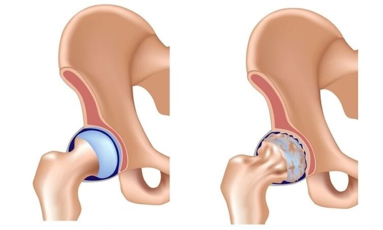 Gesond Gelenk a Gelenk mat Arthrose