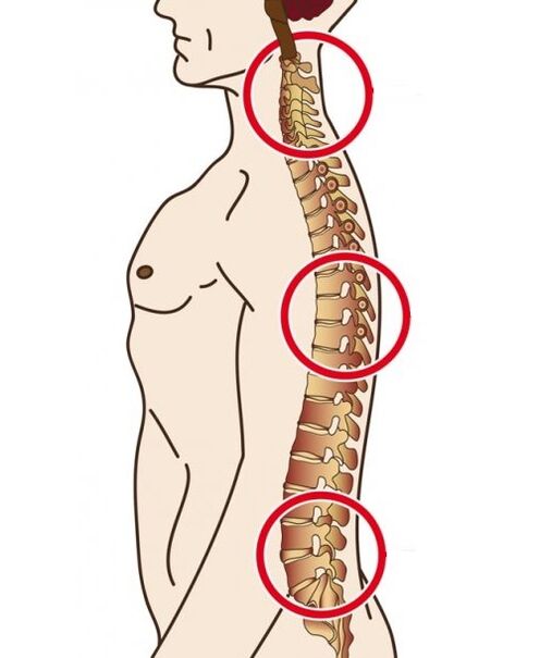 spinal Departementer an deenen Osteochondrosis geschitt