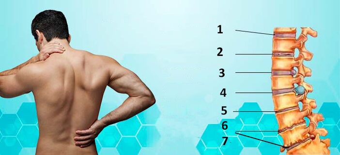 Etappe vun der Entwécklung vun Osteochondrose