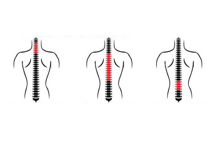 Wéi manifestéiert Osteochondrose