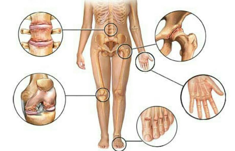 Aarte a Grad vun Arthrosis
