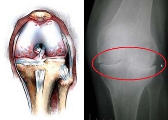 Osteoarthritis vum Kniegelenk