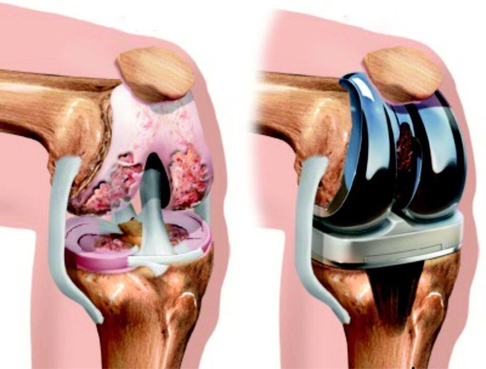 Am Fall vun totalen Schued am Kniegelenk duerch Arthrosis, kann et duerch Endoprothetik restauréiert ginn