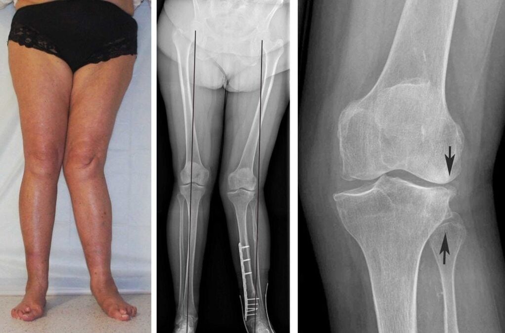 Fortgeschratt Arthrosis vun de Kniegelenken ass kloer visuell visuell och ouni Röntgenstrahlen